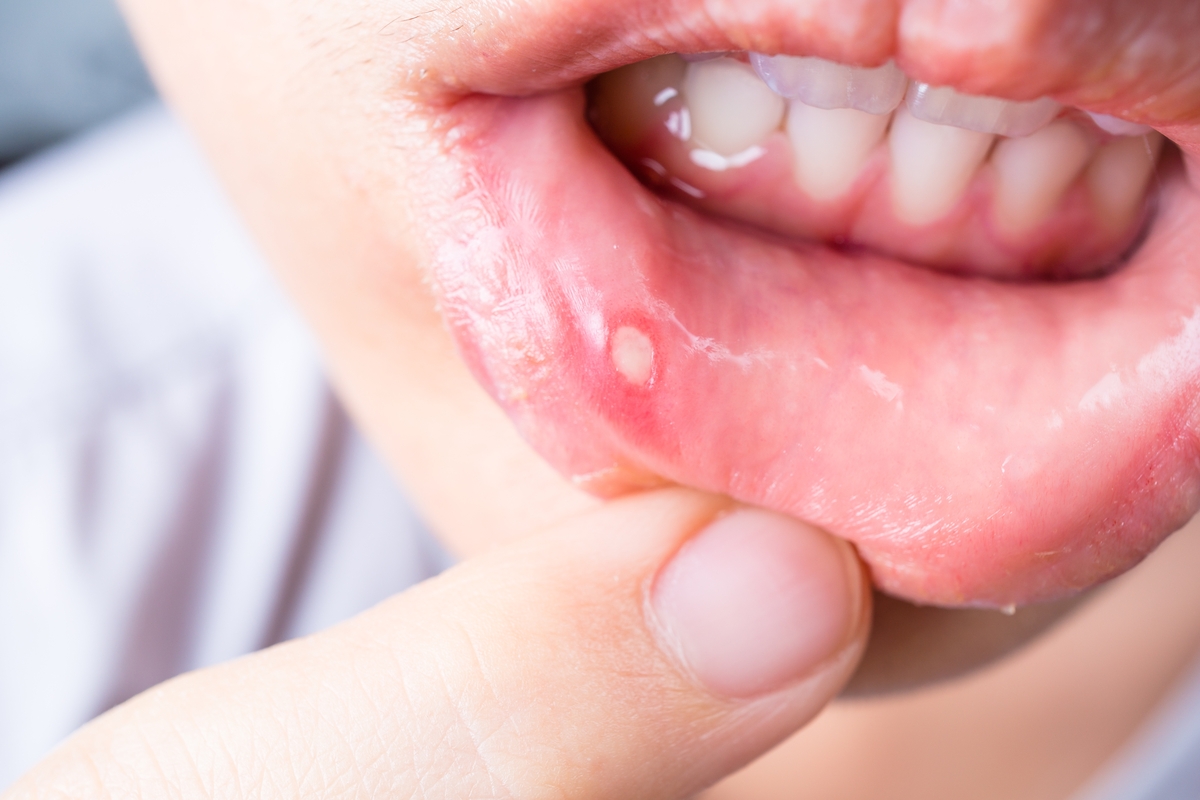 Llaga en el labio (AdobeStock)