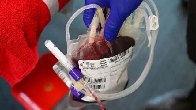 Una mano enguantada sostiene una bolsa de sangre médica llena de sangre roja cardada y conectada a tubos transparentes.