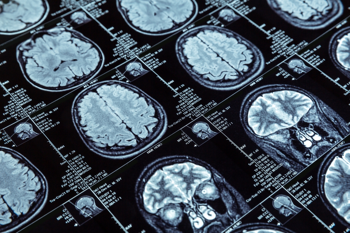 Resonancia magnética del cerebro (Shutterstock)