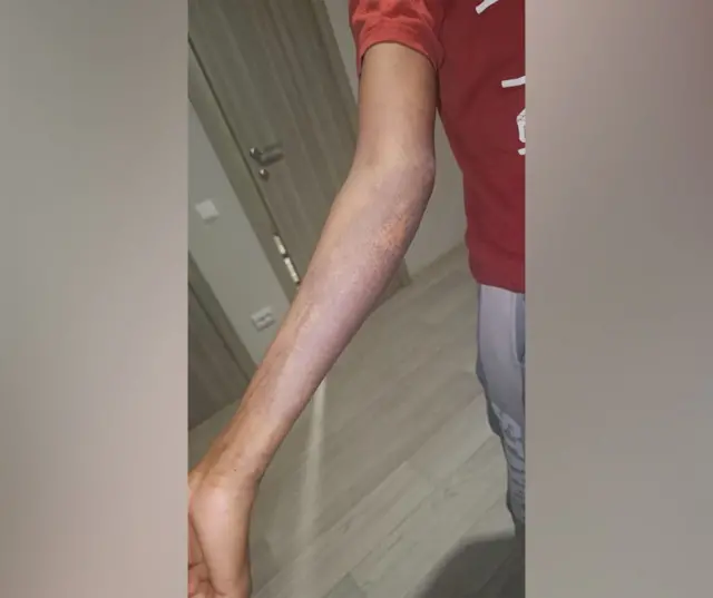 Un hombre extiende su brazo. Tiene manchada un área amplia.