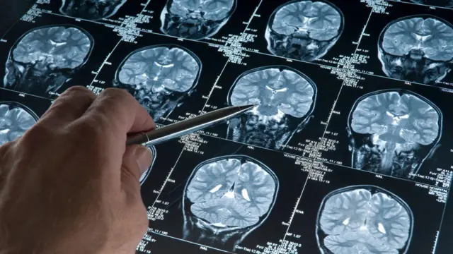 Una mano apuntando a una resonancia magnética cerebral de la cabeza y el cráneo