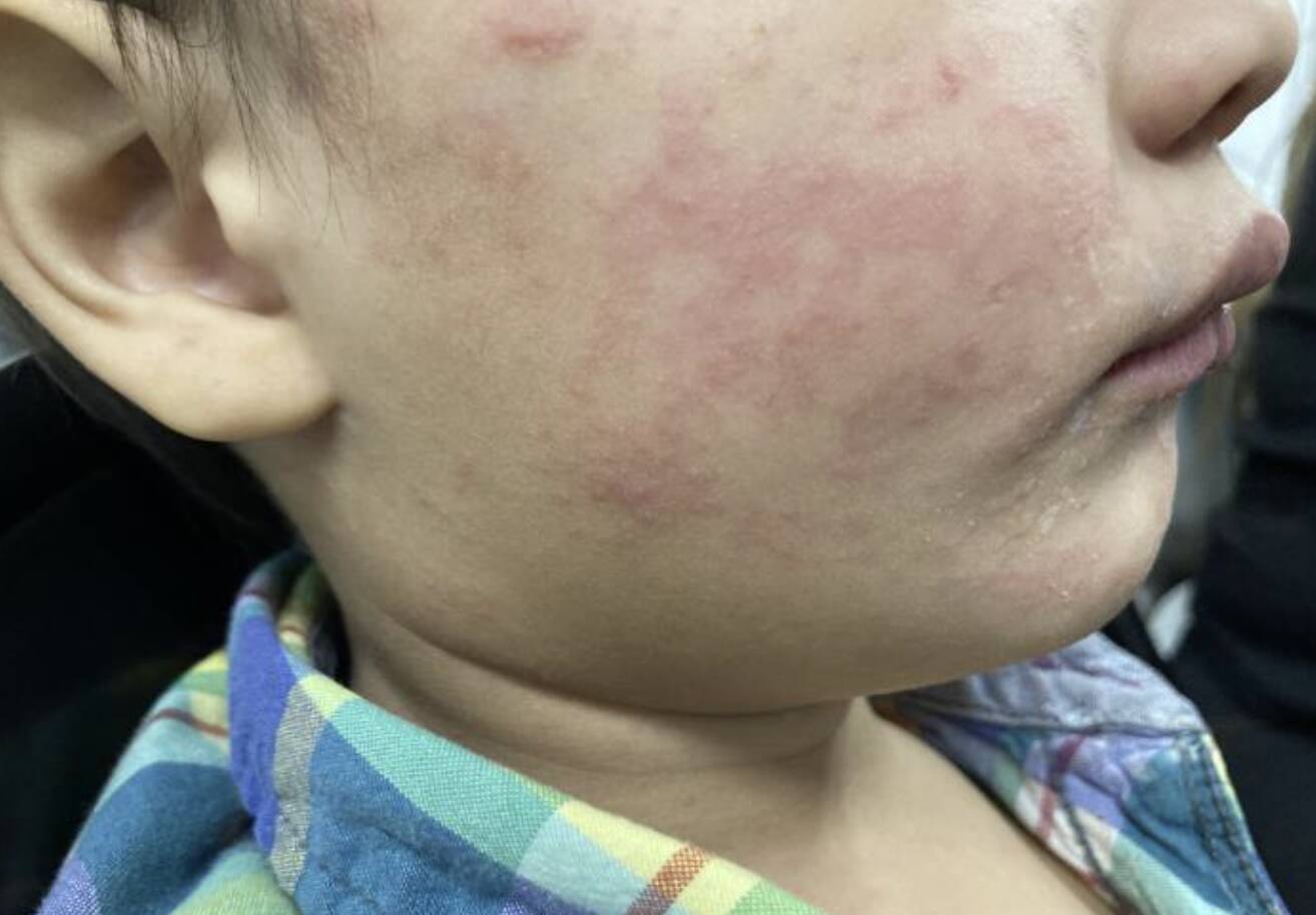Foto: Uno de los niños contagiados en un nuevo brote de sarampión (CDC)