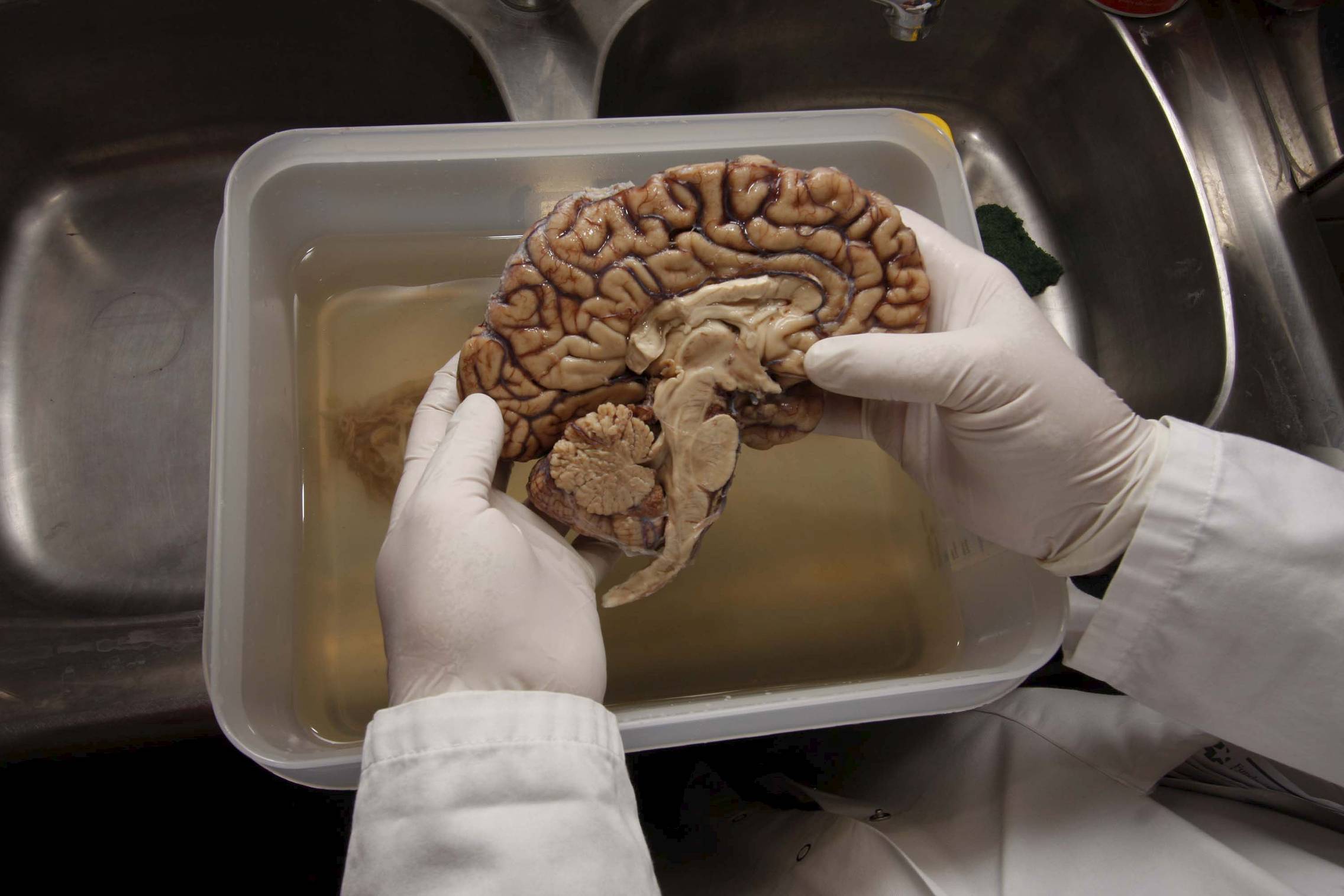 Foto: ESPAÑA TIENE UN NUEVO BANCO DE CEREBROS, QUE AYUDARÁ A ENTENDER EL ALZHEIMER