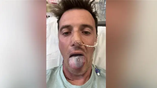 Anthony Perriam está sentado en una cama de hospital con un tubo que le sale de la fosa nasal. Saca la lengua, que presenta un color azulado en la mitad de su superficie.