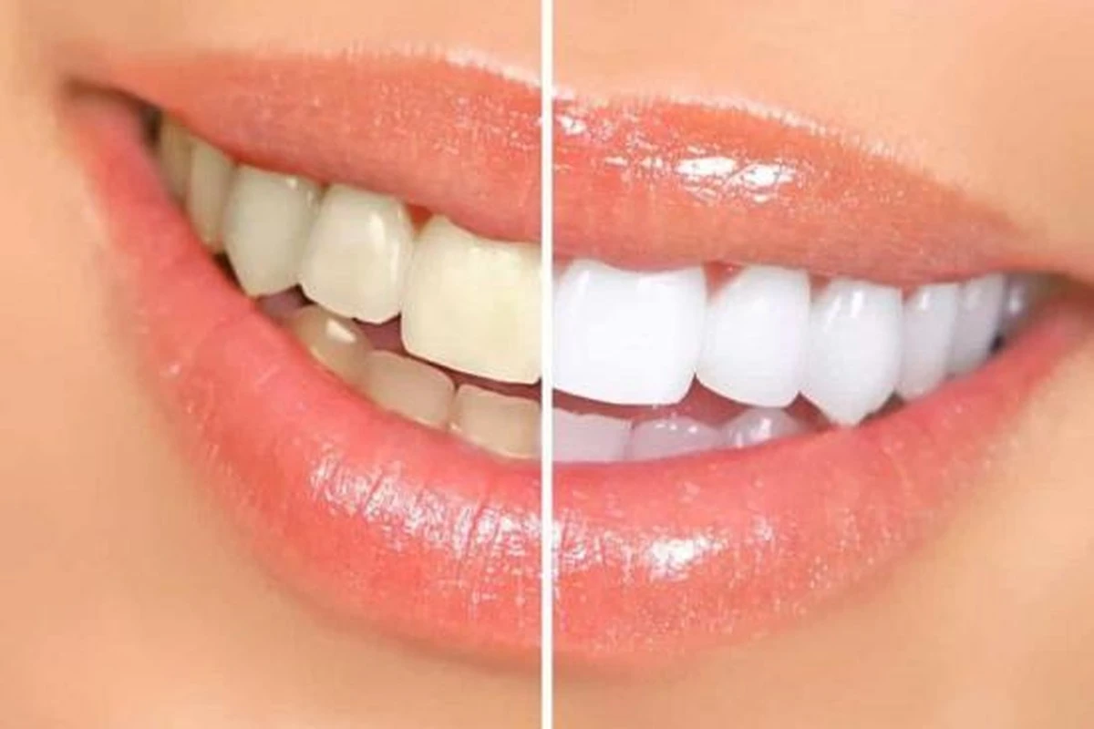 Clara como la TV: el costo de un blanqueamiento dental indoloro para una sonrisa de anuncio - image 1