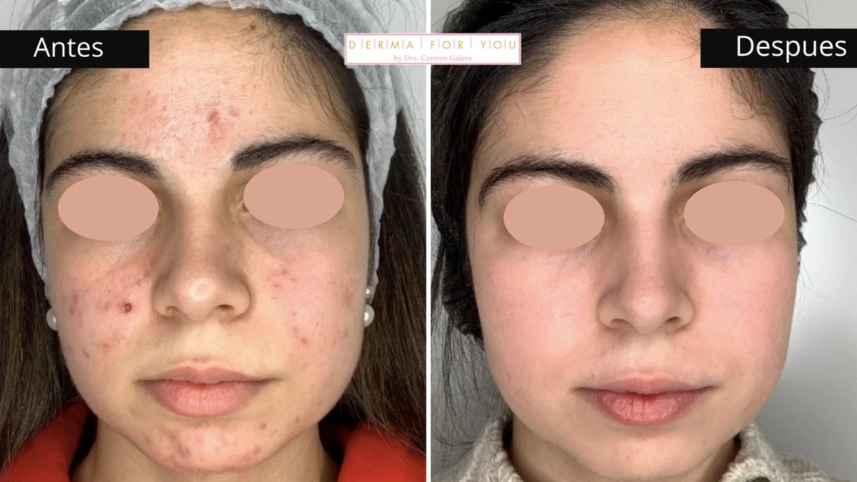 ¿Cuánto cuesta tu sueño de piel lisa? La verdad detrás de los tratamientos para borrar cicatrices de acné - image 1