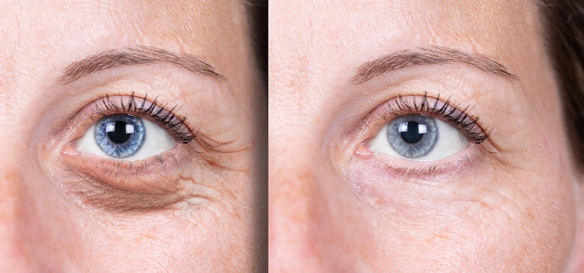 El láser para ojeras en 2026: cuánto cuesta el secreto para despertar radiante - image 1
