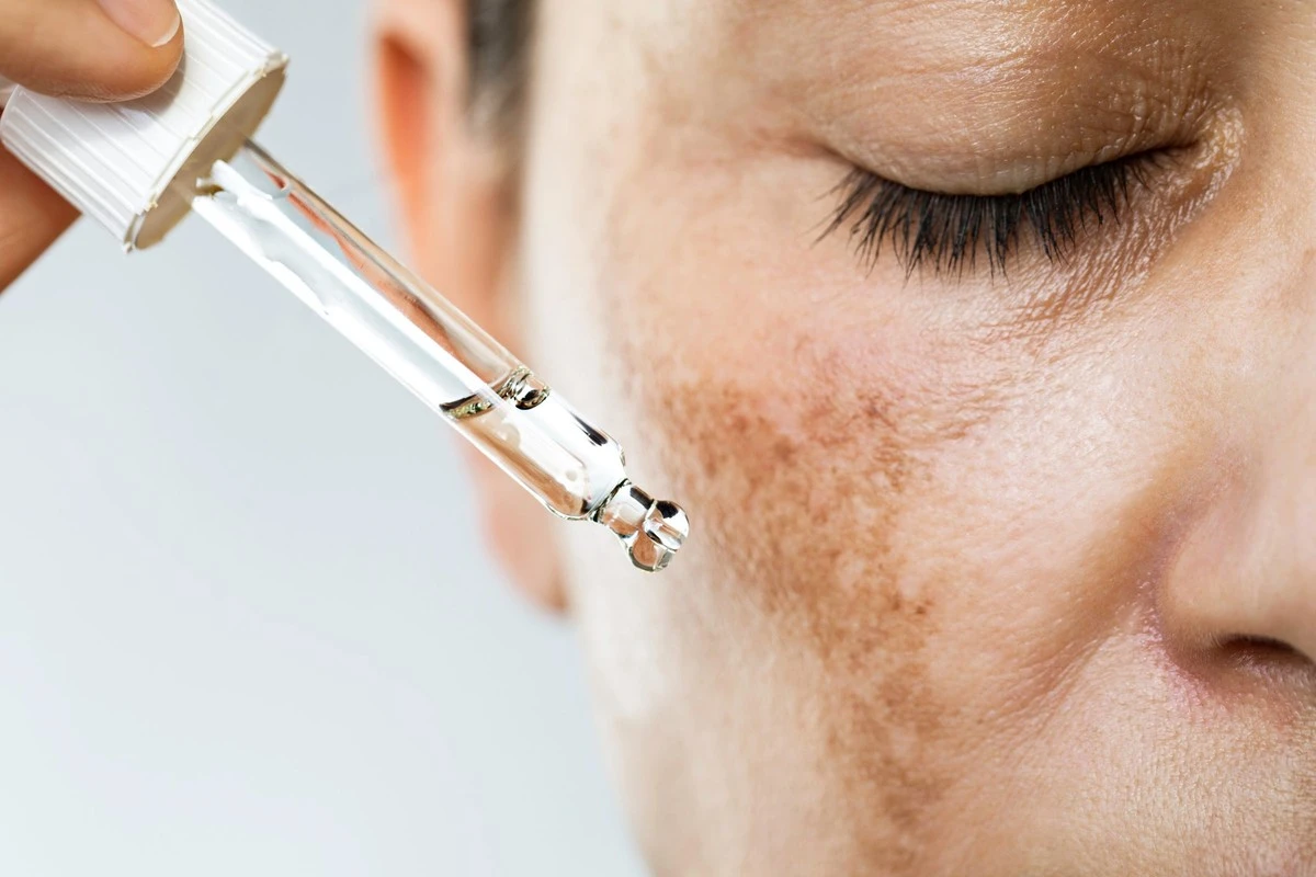 Melasma: ¿Cura Definitiva? Por Qué la Clave está en el Control Constante - image 1