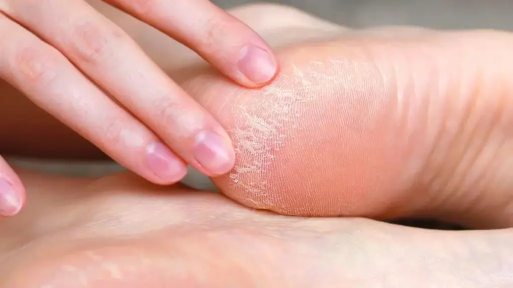 Por qué las podólogas siempre recomiendan aplicar urea en los talones por la noche