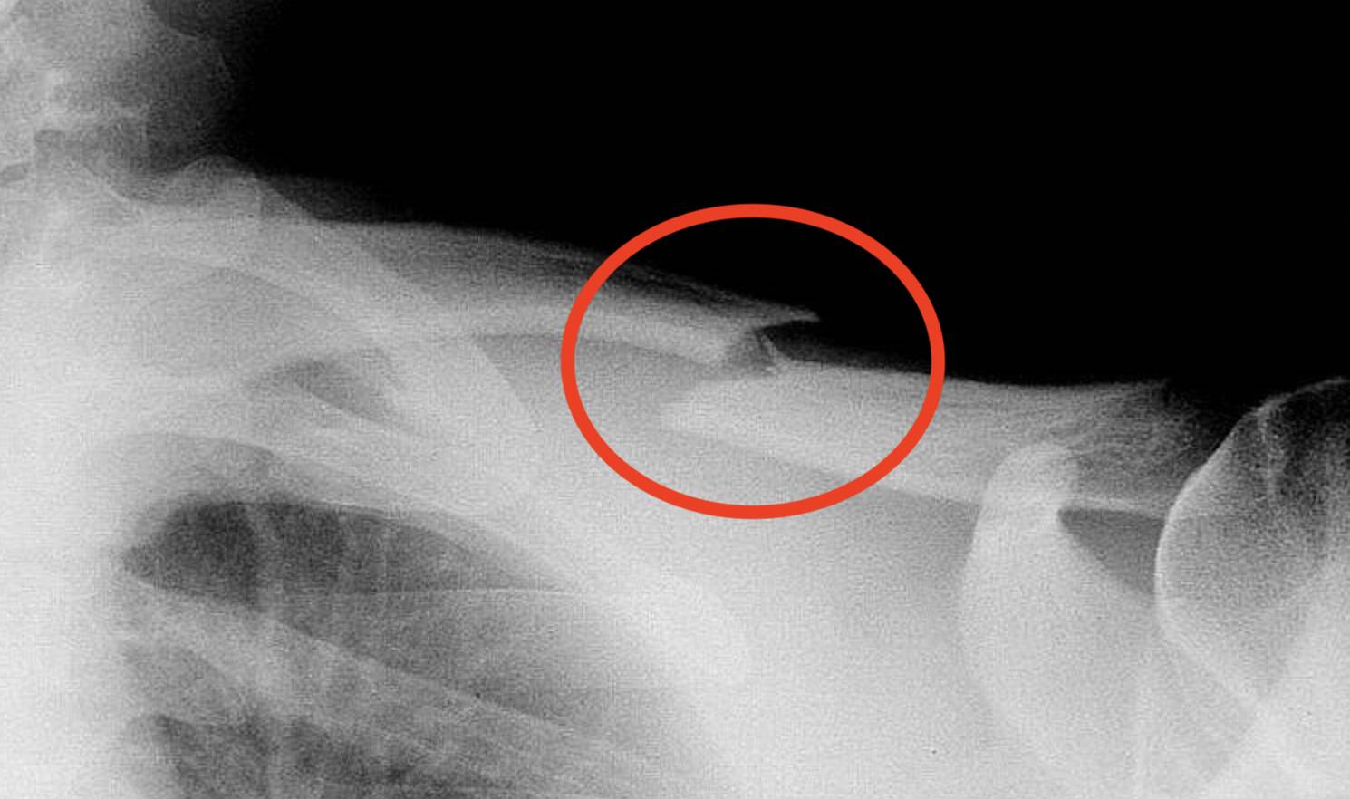 Foto: Radiografía que muestra una fractura de clavícula (Wikimedia Commons)