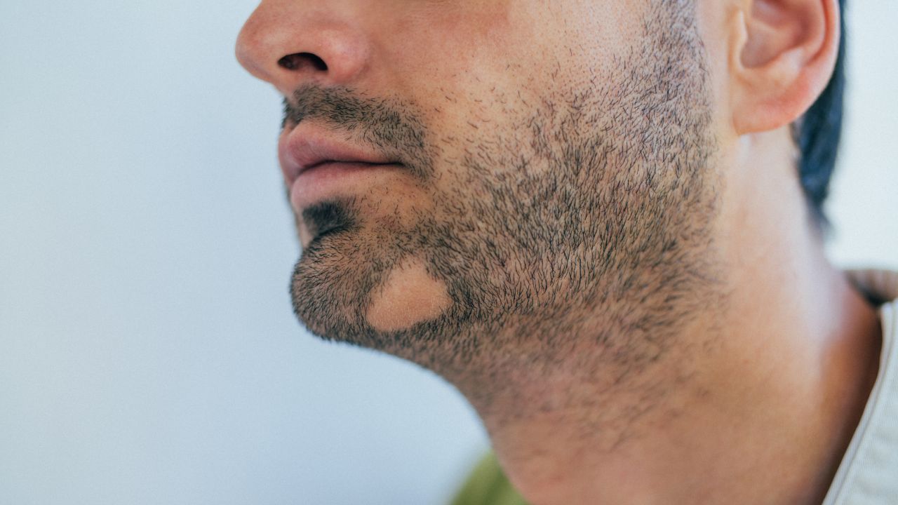 Foto: Calva en la barba. (iStock)