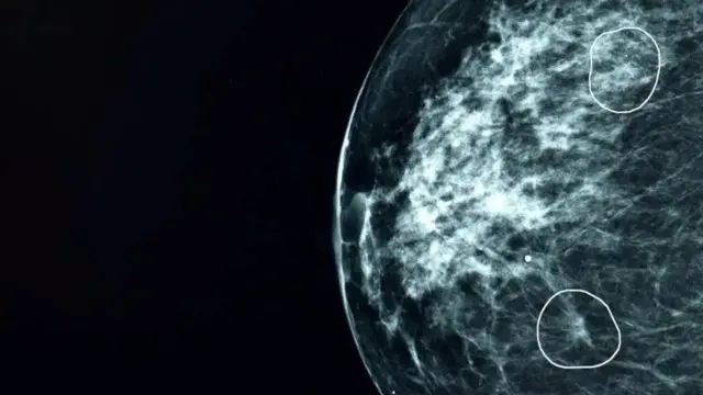 La herramienta de inteligencia artificial Mia marca dos áreas que pueden generar preocupación en una mamografía.