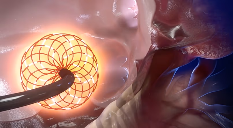 3D Computer animation of the new catheter, currently under clinical studies