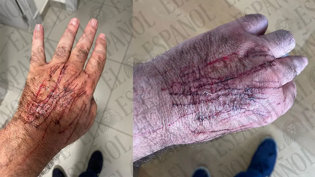 Las heridas de Koldo García provocadas por la gata de José Luis Ábalos.