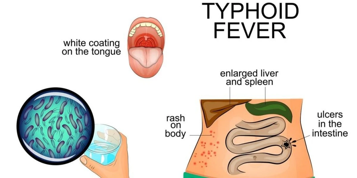 Una cepa de fiebre tifoidea ignora casi todos los antibióticos: así puedes protegerte - image 1
