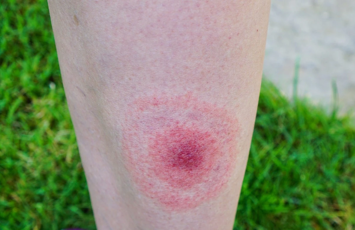 Adiós a las Garrapatas y la Borreliosis: el truco del ajo que pocos usan - image 1