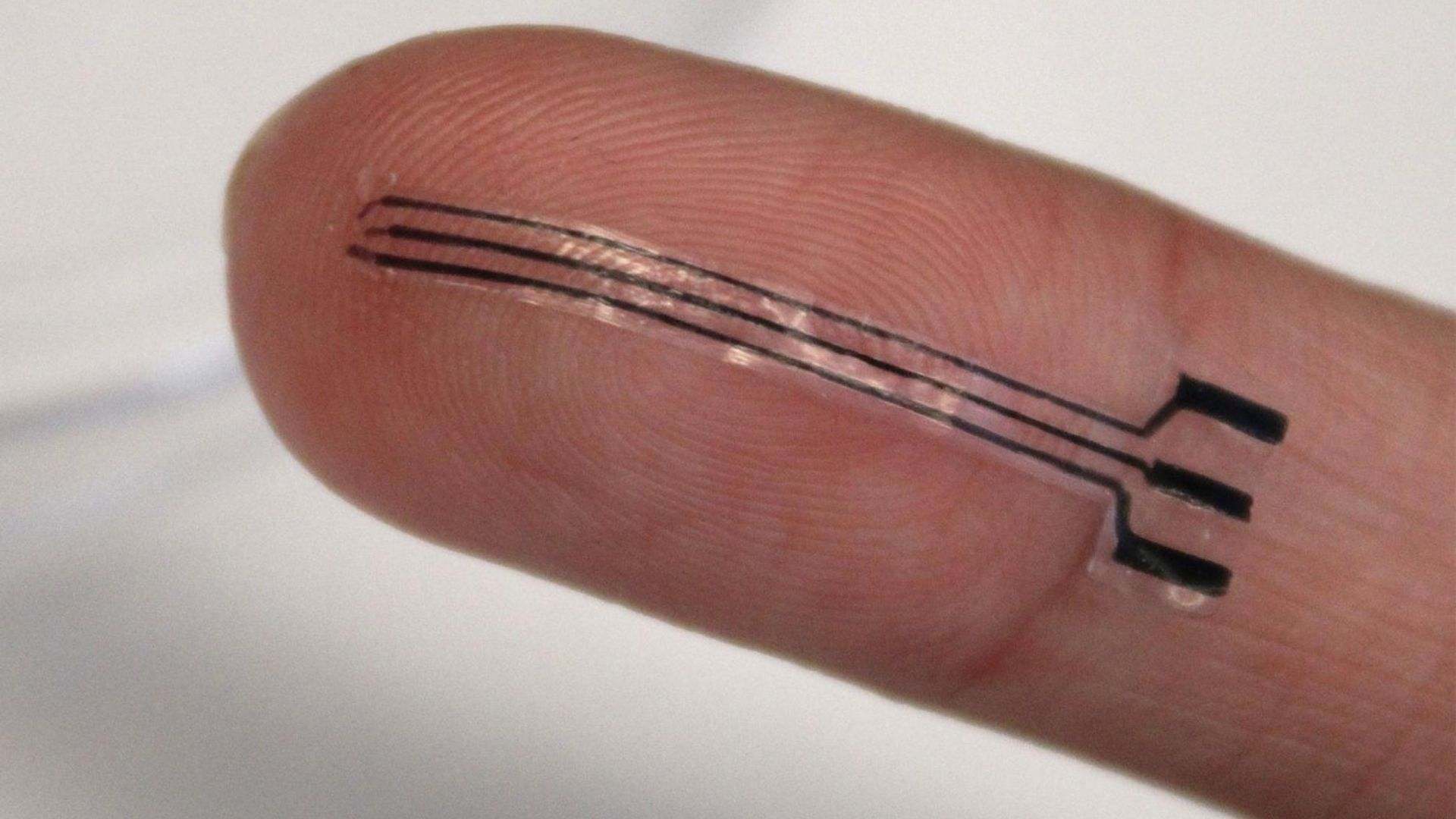 Un implante elástico impreso en 3D: investigadores confirman que puede reducir la presión arterial
