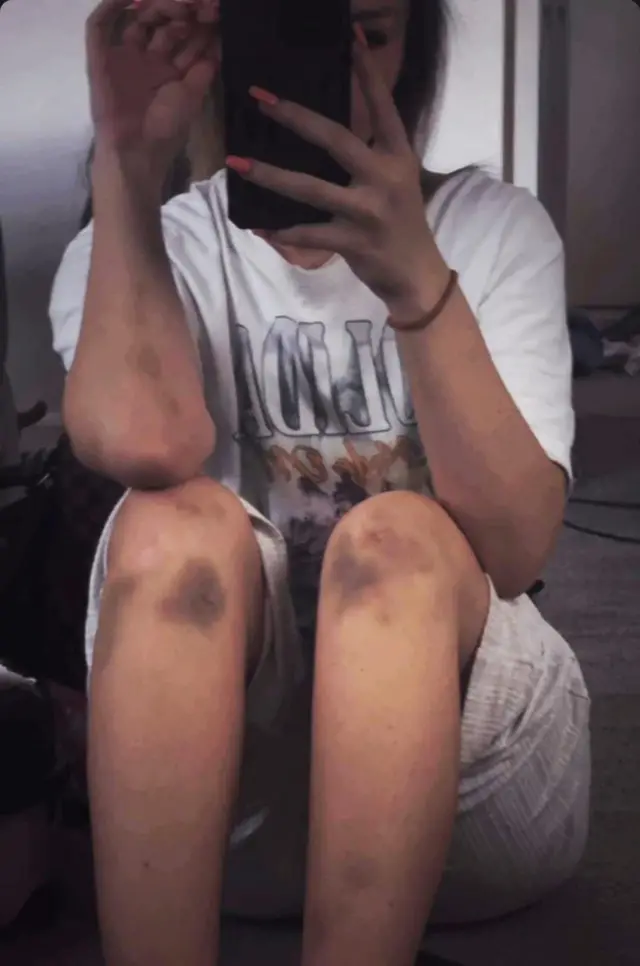 Una selfi de Rebecca sentada, con el rostro oculto tras su teléfono móvil. Lleva pantalones cortos grises y presenta hematomas oscuros en ambas rodillas, así como moratones que se extienden por los brazos.