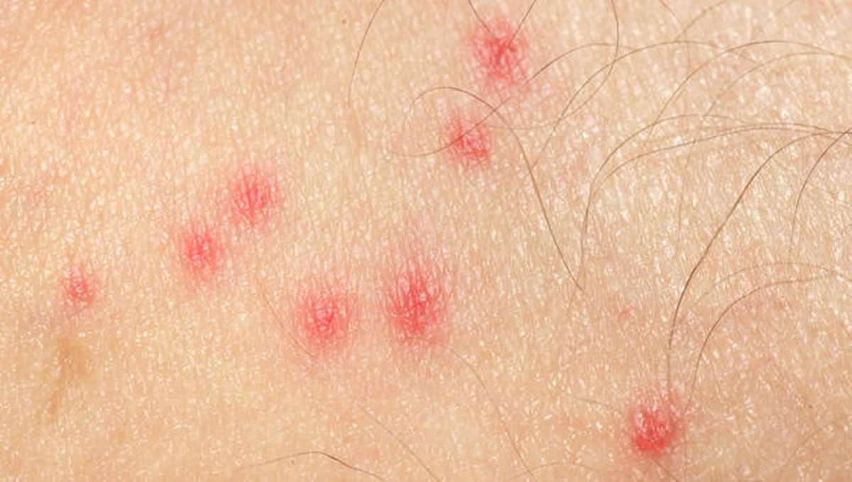 Alerta en Torres Vedras: por qué los mosquitos son hoy más peligrosos en Maceira - image 1