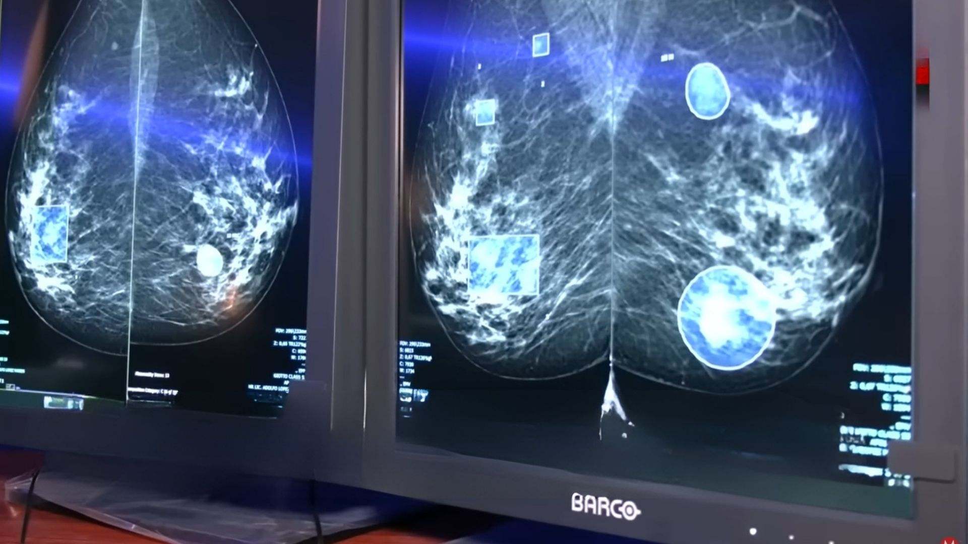 La IA ya es capaz de detectar tumores impalpables para el diagnóstico temprano de cáncer de mama