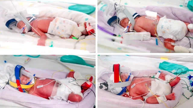 Los bebés cuatrillizos que aparecen en una imagen compuesta se encuentran en la sala de neonatos del hospital, en una incubadora, con un respirador artificial y varios cables conectados.