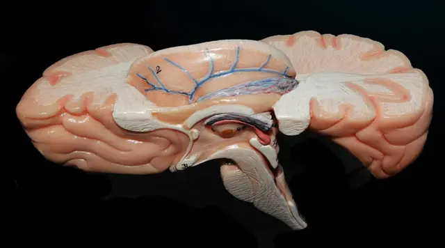 Un modelo de cerebro sobre un fondo negro. Las partes rosas del cerebro tienen líneas; en el centro hay líneas negras