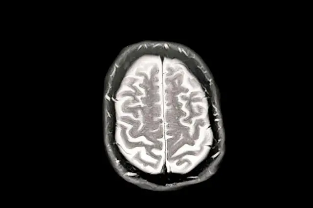 Un escaneo cerebral que muestra la enfermedad temprana de Alzhéimer. La imagen del cerebro es blanca sobre un fondo negro